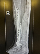 Contusion y Hematoma.JPG (973898 bytes)